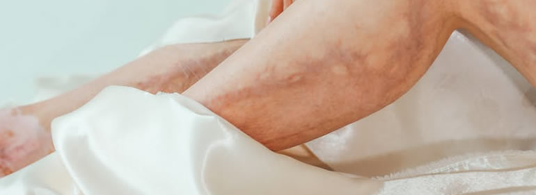 Masaje Desvanecimiento de Varices